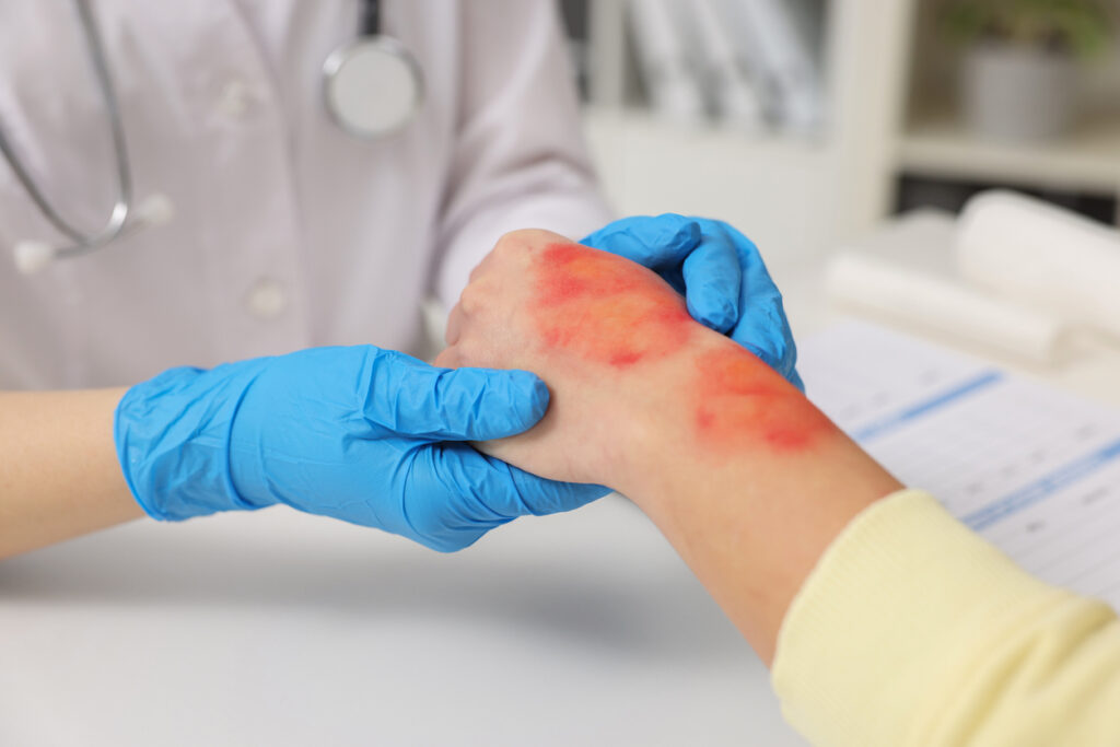 Burn Injuries Lawyer in Norcross, Gwinnett County